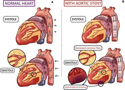 TEVAR and EVAR, the unknown knowns of the cardiovascular hemodynamics; and the immediate and long-term consequences of fabric material on major adverse clinical outcome